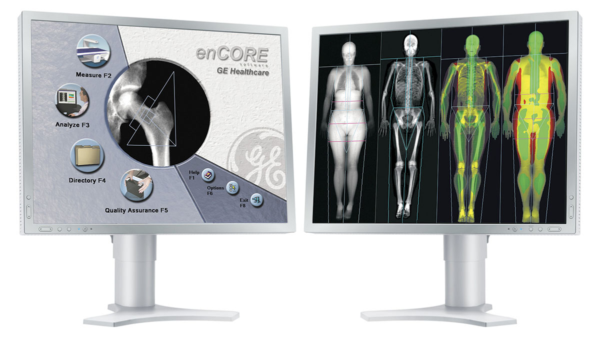 Understanding your dexa scan report