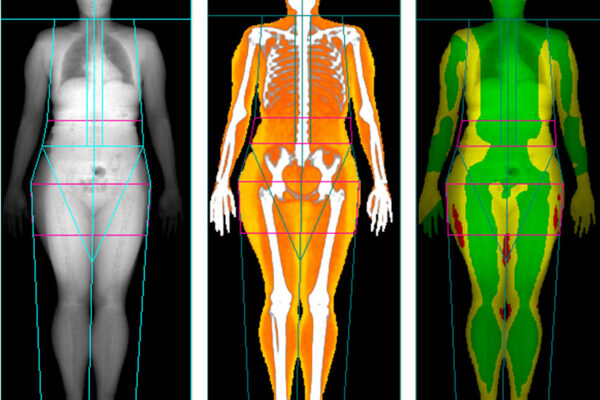 DEXA Xray Live Lean Rx Houston